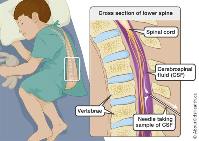 Graphic of child lying on side - it shows a cross section of lower spine with needle inserted between vertebrae taking a sample of cerebrospinal fluid