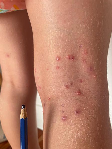 Photo showing molluscum contagiosum on the skin