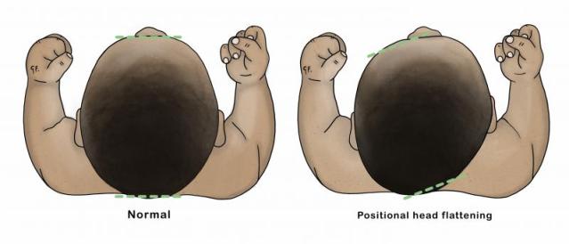 Illustration showing plagiocephaly/positional head flattening in a baby 