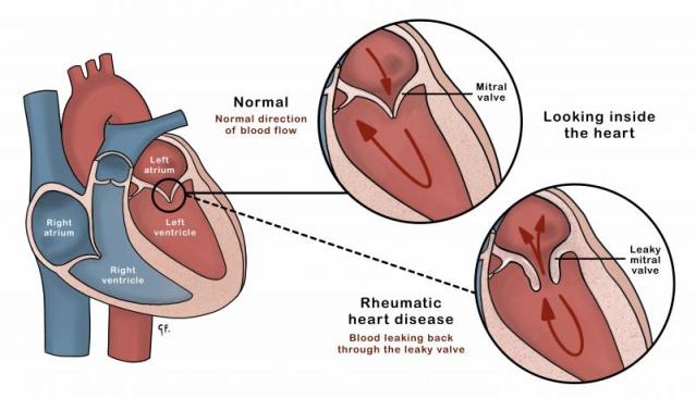 Anatomical drawing of the heart on the left showing 2 insets to the right one with normal valves and the other with valves affected by rheumatic heart disease.