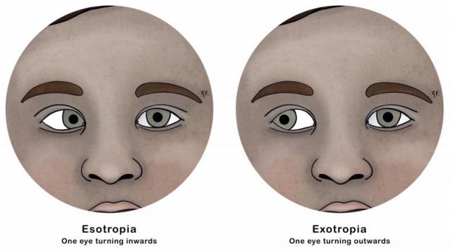 Illustration show esotropia and exotropia