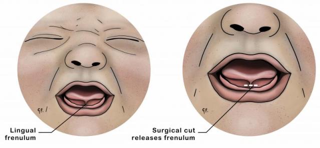 Illustration showing tongue tie in a baby on the left. On the right, the graphic shows where the snip is made to the frenulum in a tongue-tie release