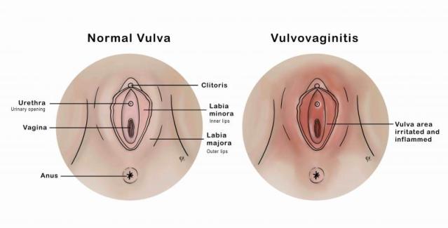 Medical illustration showing a normal vulva and vulvovaginitis