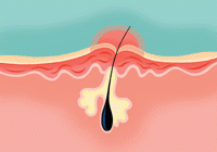 A diagram showing a pimple