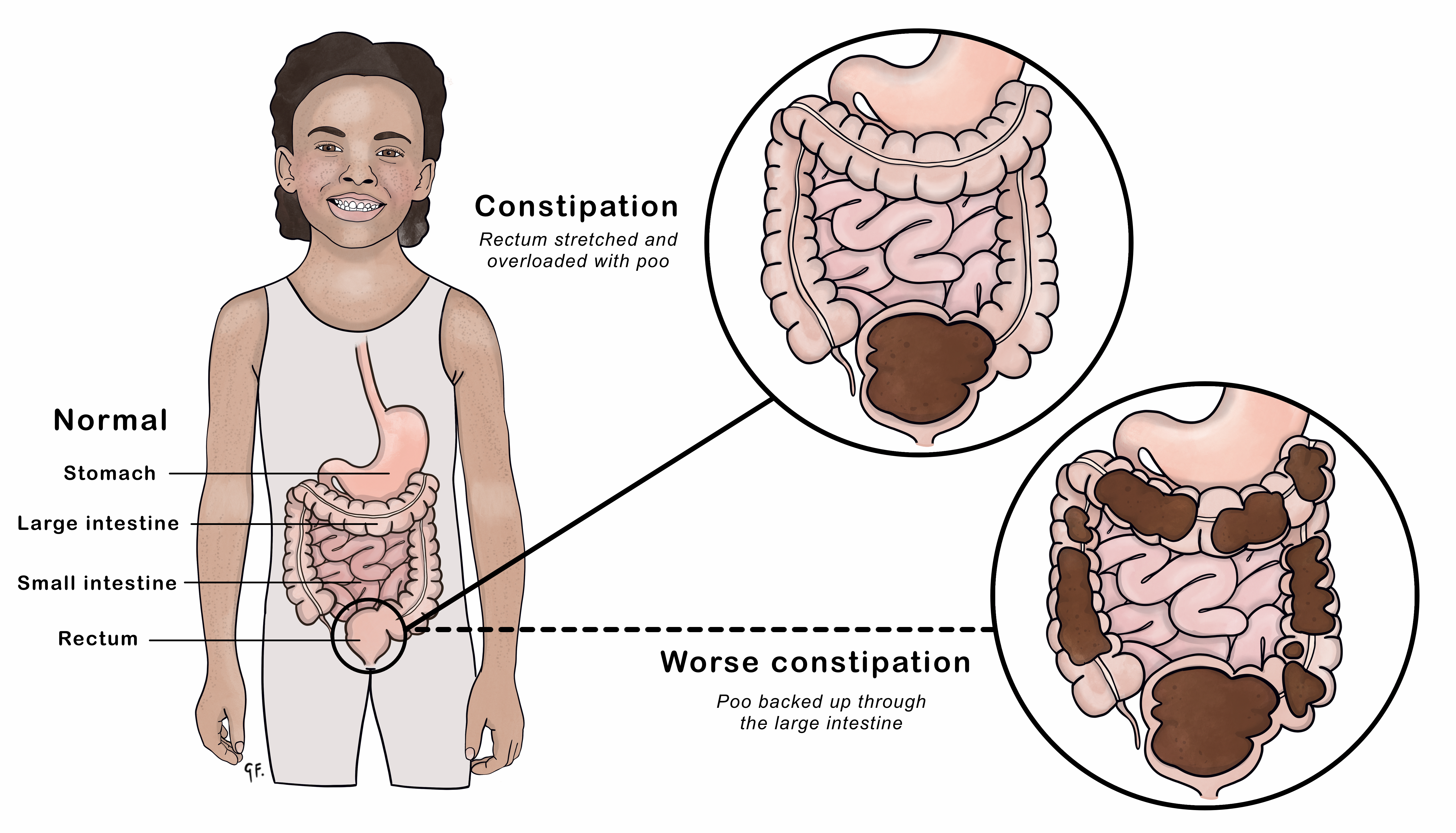 Continence In Kids, Constipation, What's 'Normal