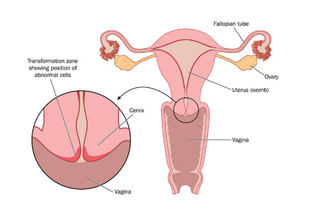 Diagram of the cervix showing where abnormal cells develop