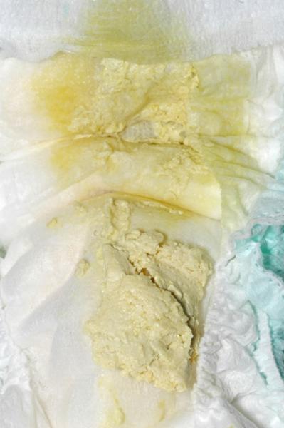 The photo below shows a nappy with both a pale stool and dark urine.