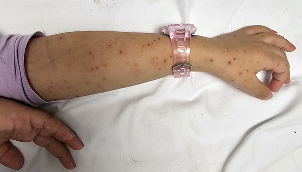A girl's arm showing a meningococcal rash