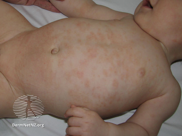 Eczema on the body of a baby