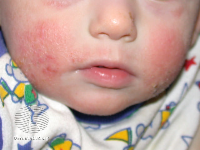 Baby with eczema on cheeks
