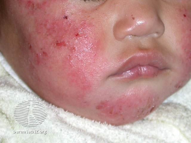 Eczema on a baby's face