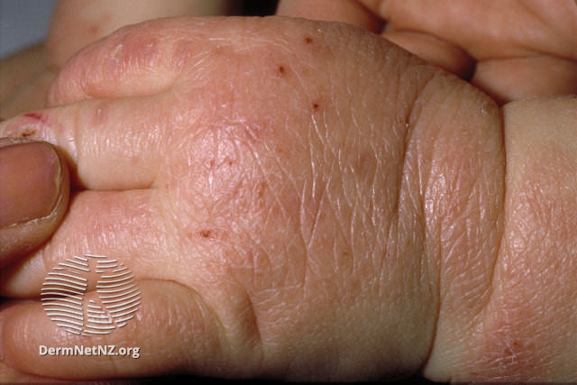 Eczema on a baby's hand