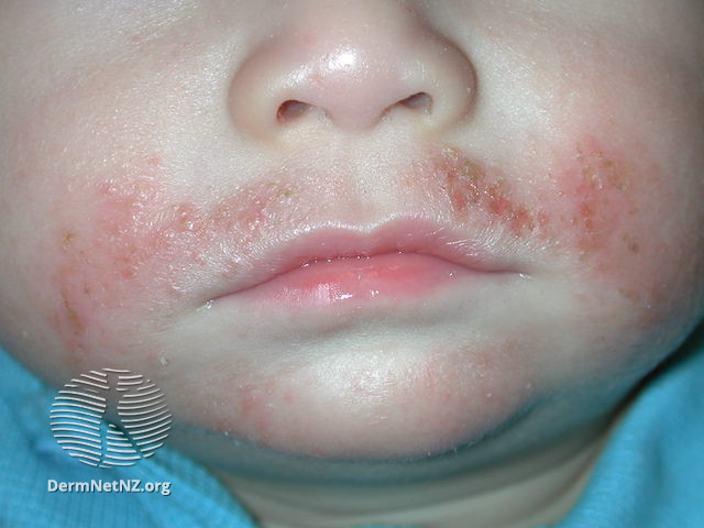 Baby with infected eczema