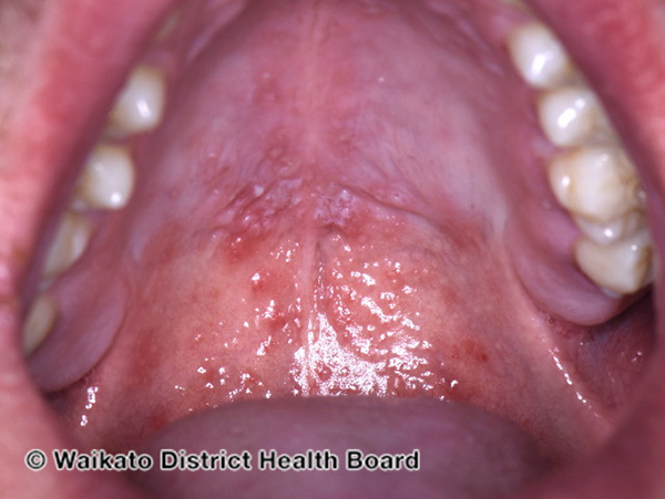 Photo of blisters in a child's mouth