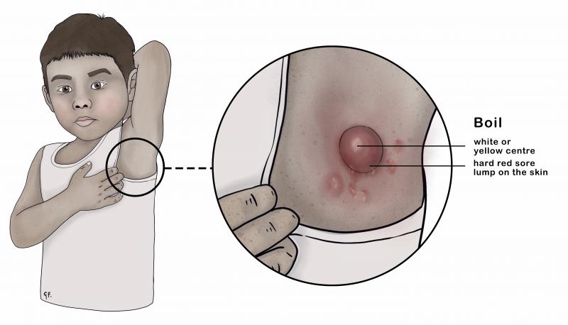 Illustration showing a child with a boil under the armpit