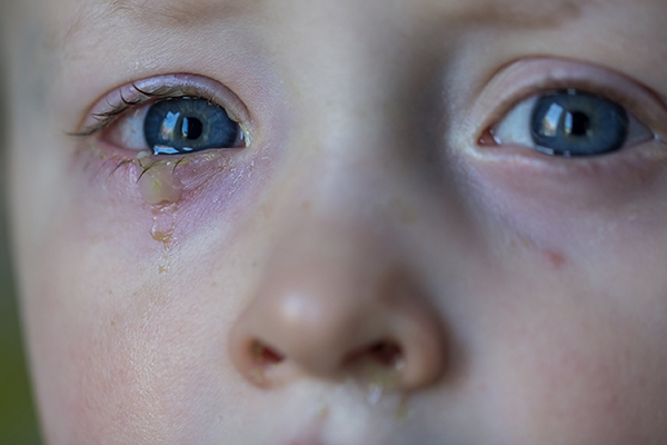 A boy with conjunctivitis