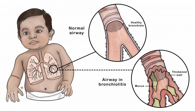 Illustration showing a baby with close up of normal airway and an airway affected by bronchiolitis 