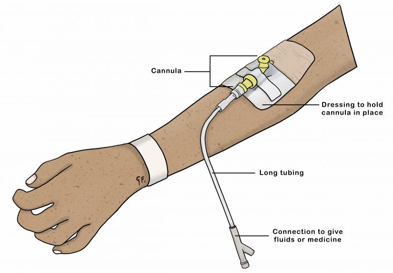 Illustration showing a childs arm with a cannula in it 
