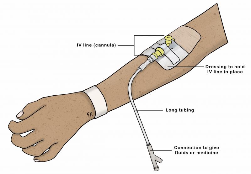 Illustration showing a childs arm with a cannula in it 