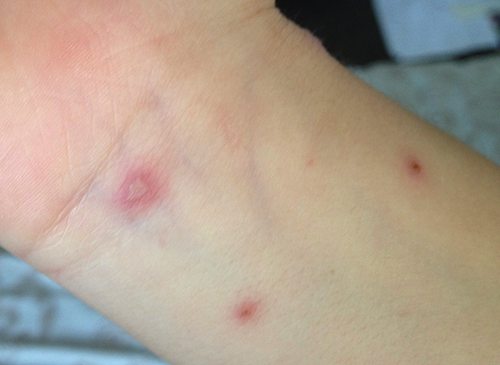 Photo of a chickenpox rash on a child's arm and wrist