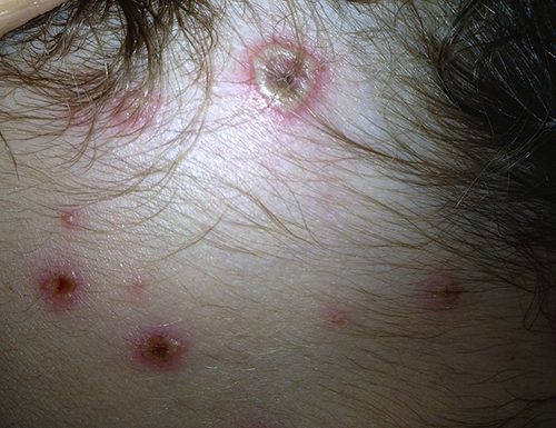 Photo of chickenpox blister on a child's scalp