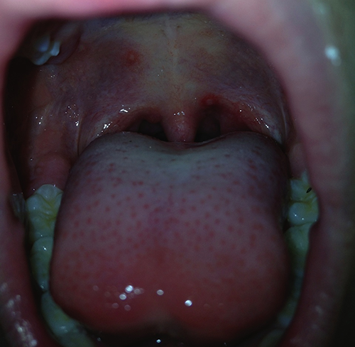 Photo of a chickenpox rash in a child's mouth