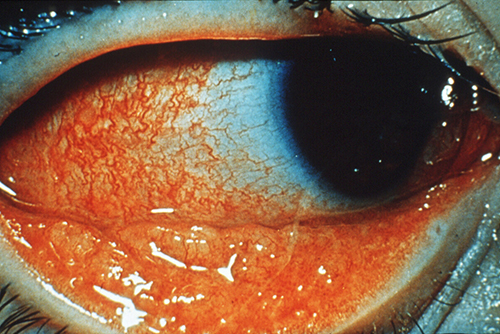 Photo of child's eye with conjunctivitis