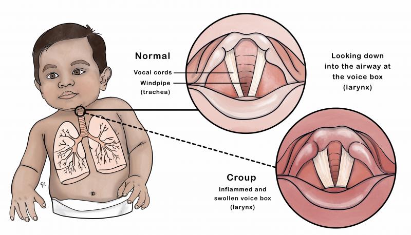 Illustration of the changes in the airway with croup in an infant