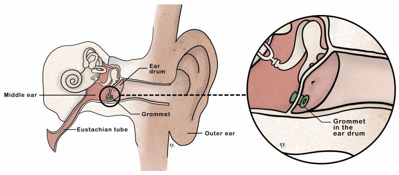 Illustration showing inner ear anatomy with a grommet in place