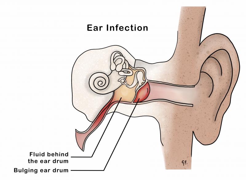 Illustration showing inner ear anatomy with an ear infection or otitis media
