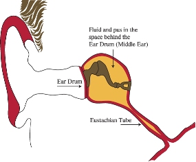 Diagram of the ear showing fluid in the middle ear