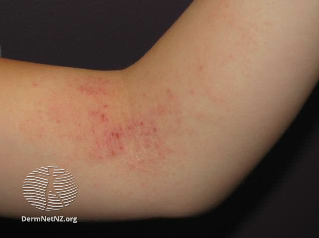 Eczema on a  child's arm