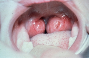 photo showing enlarged tonsils