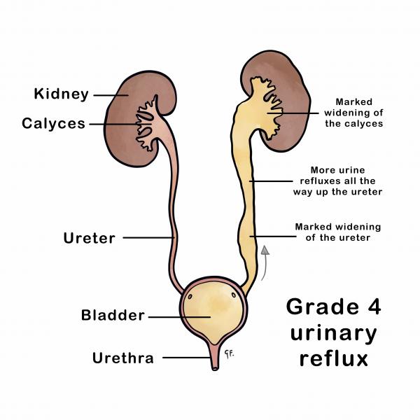 Grade 4 urinary reflux with genitourinary anatomy