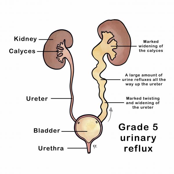 Grade 5 urinary reflux with genitourinary anatomy