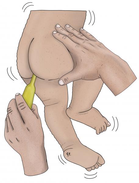 Illustration of parent giving young child rectal diazepam for a seizure 
