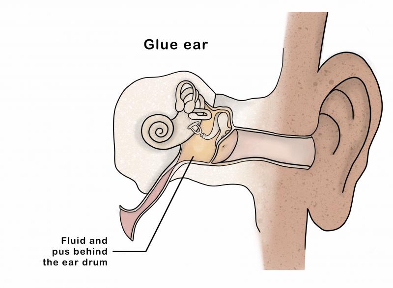 Glue Ear | KidsHealth NZ