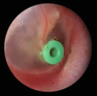 Photo of grommet in place in the ear drum