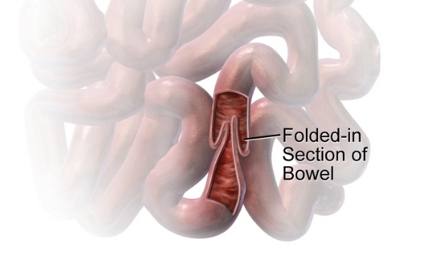 Image showing how intussusception affects the bowel