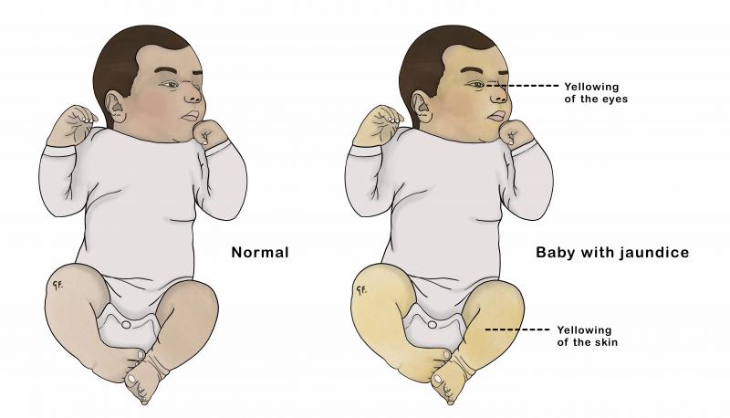 illustration of normal infant next to jaundiced infant