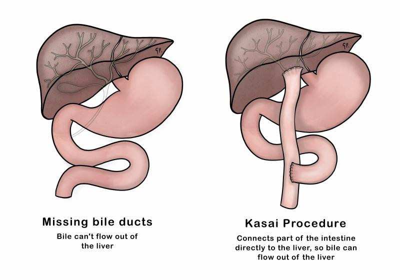 Illustration showing Kasai procedure used for biliary atresia