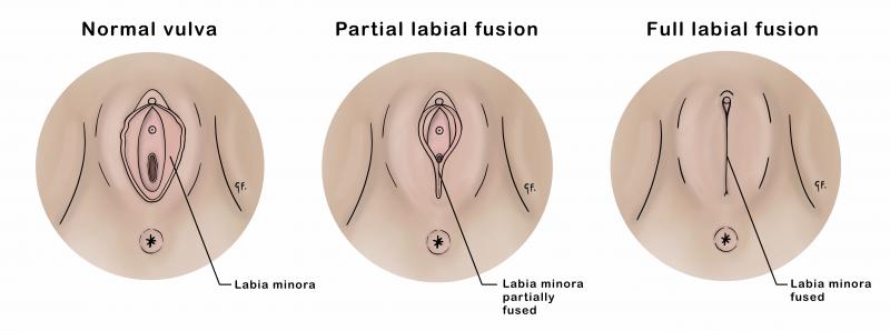 Medical illustration showing partial and full labial fusion alongside a normal vulva