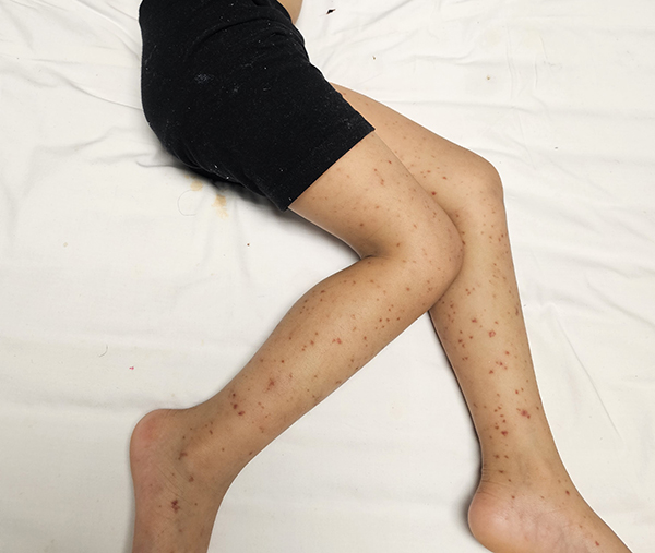A girl's legs showing a meningococcal rash
