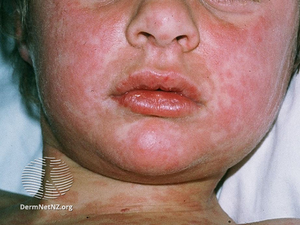 Photo of a boy's face with measles rash