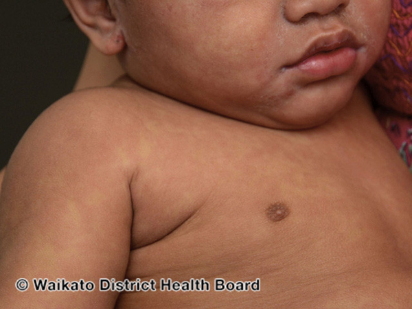 Photo of measles rash on young child