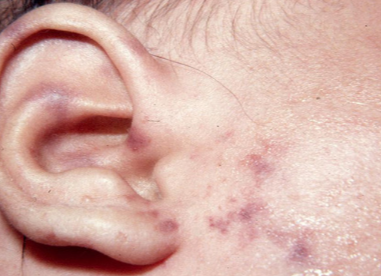 An ear with meningoccal rash on an ear