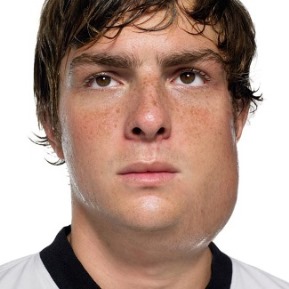 Photo of a boy with mumps showing swelling in the glands on one side of his face