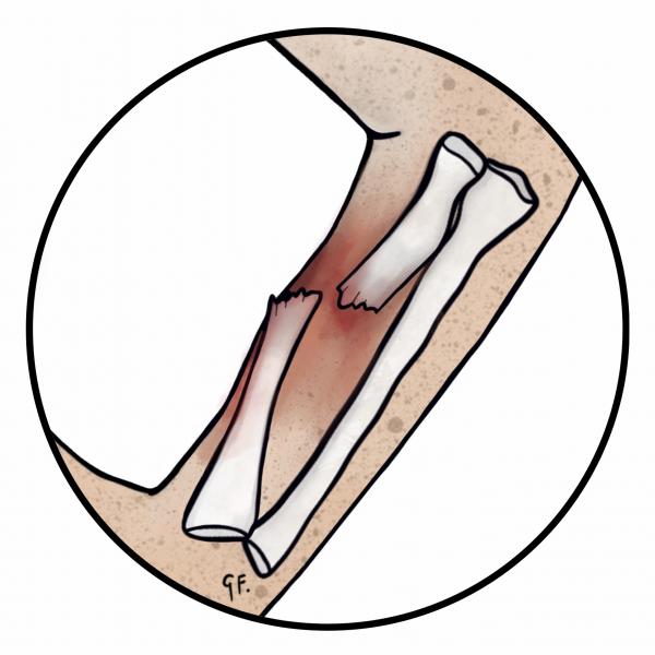 Illustration of an open fracture of the arm