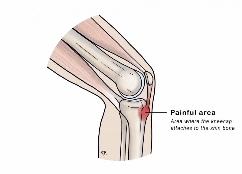 Knee showing painful area in osgood-schlatter disease