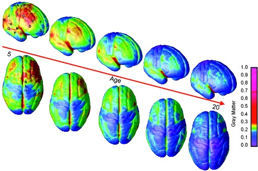 Immagine di cervelli che mostrano un colore blu crescente dai 5 ai 20 anni